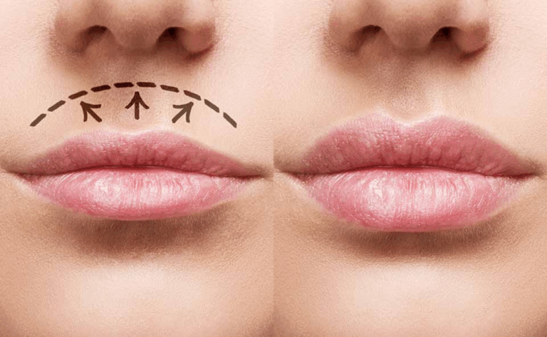 Lip lift – najczęściej zadawane pytania i odpowiedzi